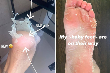 Baby Foot Peel Photos