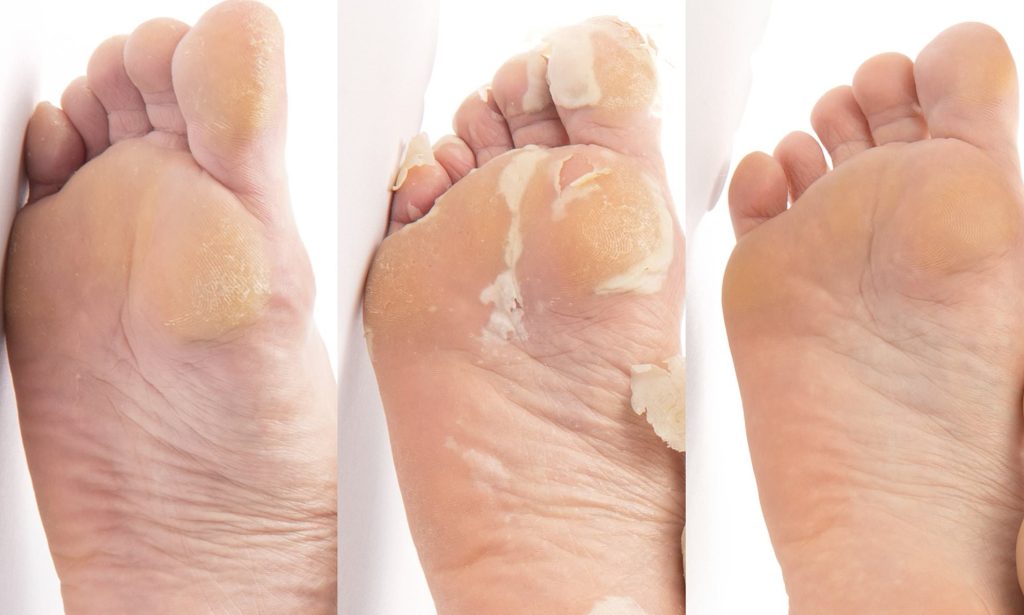 Sole of Foot Peeling